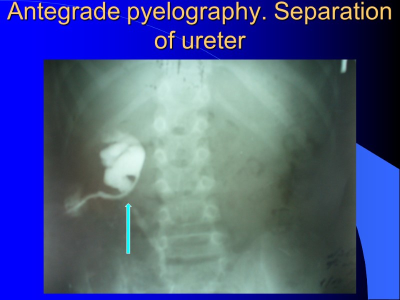 Antegrade pyelography. Separation of ureter Antegrade pyelography. Separation of ureter
